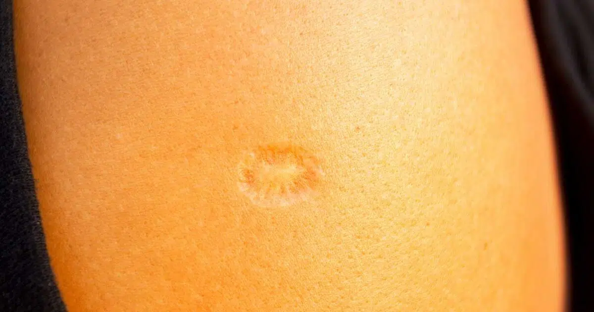 Why So Many People Have A Small Scar On Their Left Arm